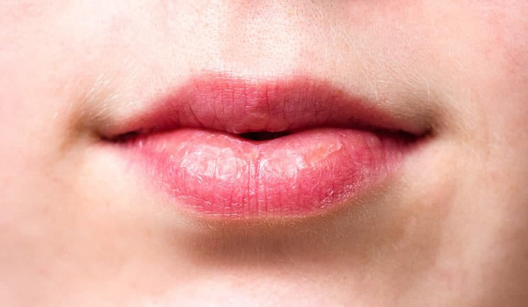 Заеды в уголках рта – быстрое лечение